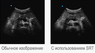 Технология SRT (снижение зернистости) Технология SRT (снижение зернистости)